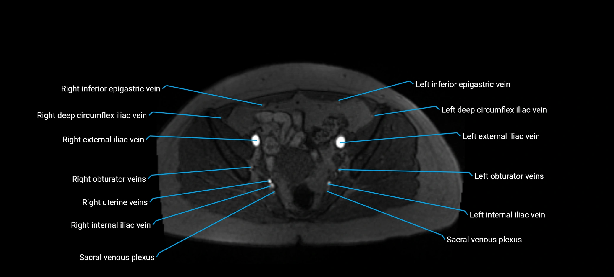 MRV abdomen pelvis & lower limb axial cross sectional anatomy labelled MRI image 156 (1).webp